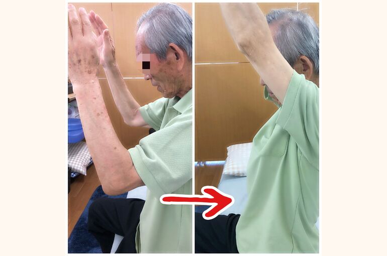 ビフォーアフター五十肩