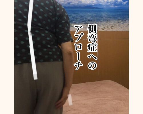側彎症モデル