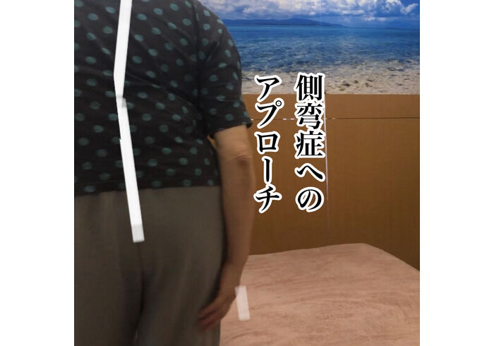 側彎症モデル