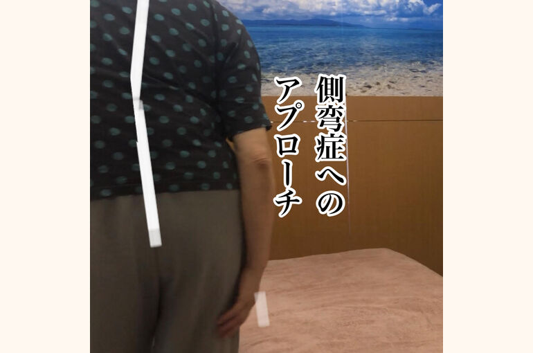 側彎症モデル