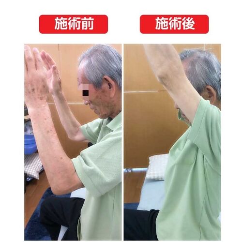 五十肩の激痛も改善！